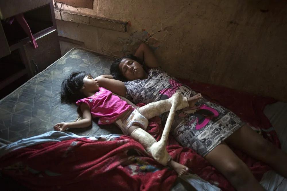 秘鲁利马贫民窟里2岁的达丽丝因营养不良,腿上戴着治疗髋关节的石膏